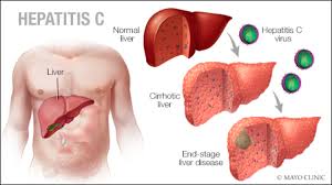 Гоу вунмц мз рф, 2003. Trinity Lab Solves Hepatitis C Detection Problem Headstuff
