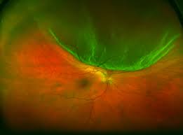 Image result for Retinal Detachment