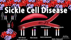 Sickle cell disease (scd) and its variants are genetic disorders resulting from the presence of a mutated form of hemoglobin, hemoglobin s (hbs) 1, 2 (see the image below). Sickle Cell Disease Animation Youtube