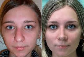 Rhino Correct Nose Job Nose Surgeon Health Beauty