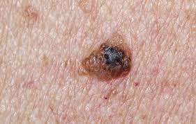 Like spots and blue veins, ingrown hairs crop up as if from nowhere. 5 Signs Of Skin Cancer That Are Easy To Overlook Bicycling