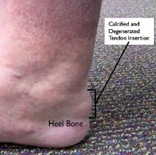 Achilles Tendinitis Orthoinfo Aaos Tendonitis Treatment Achilles Tendonitis Treatment Insertional Achilles Tendonitis