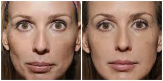 You don't feel that hungry but it takes about 3 hours to flush your system. More Amazing Before And Afters Of Sculptra Photos Courtesy Of Dr Burke Robinson Sculptra Sculptra Face Fillers Botox Fillers