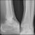 X Ray Ankle Fracture