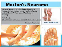 Morton S Neuroma Morton S Neuroma Neuroma Neuroma Surgery