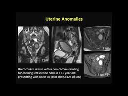 Ismrm Education Series Body Genito Urinary Mri Female Pelvis Part 2 Youtube