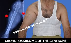 Image result for Chondrosarcoma