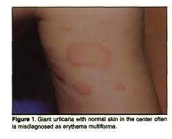 Image result for Erythema Multiforme
