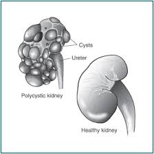 Polycystic Kidney Disease Pkd Symptoms Treatments