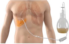 Image result for Intrapleural Anesthesia