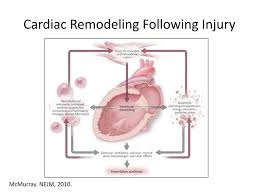 When doctors talk about remodeling, they are usually talking about the left ventricle, though occasionally this term is applied to other cardiac chambers. Ppt Heart Failure Powerpoint Presentation Free Download Id 2373017