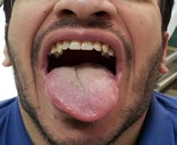 Temporary Unilateral Hypoglossal Nerve Palsy Secondary To Infectious Mononucleosis A Case Report Sciencedirect
