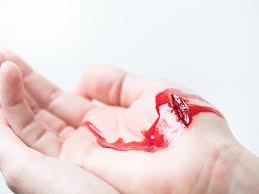 Sepsis can be deadly, so being educated on the signs is key. Blutvergiftung Lebensgefahrliche Sepsis Erkennen Und Behandeln Berlin De