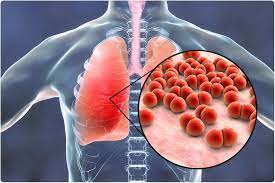 Why Improved Pneumonia Diagnosis Is Needed Now More Than Ever