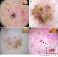 The tumors associated with this type of cancer are also typically large. Dermoscopy In Basal Cell Carcinoma An Updated Review Actas Dermo Sifiliograficas