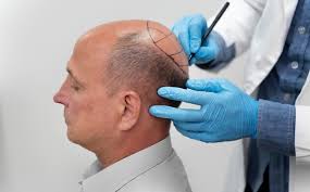 Transplantace vlasů v Turecku: ptali jsme se na vaše zkušenosti