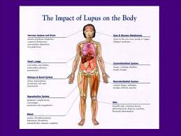 Lupus Chart Invisible Illness Multiple Sclerosis Health