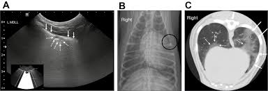 Image result for Pulmonary Contusion
