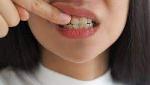 Check spelling or type a new query. Syarat Tes Kesehatan Gigi Masuk Akpol 05 September 2019 Tanya Dokter Klikdokter Com