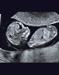 Ecografías embarazo, ¿en qué consisten? Ecografia Obstetrica Ecografia Prenatal Y Ginecologica De La Clinica Girona