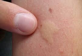 Epingle Sur Anti Insectes Et Anti Parasites