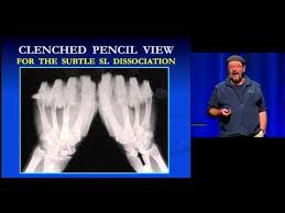 Xray Wrist Tangential Gaynor Hart Youtube