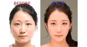 I'm moving to south korea to teach english in november and i want to get a nose job there. Plastic Surgery Is Actually A Very Common Korean Gift