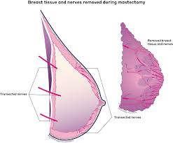 Image result for Mastectomy