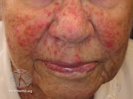 Image result for demodex rosacea