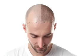FMS SKIN & HAIR, Hair Transplantation ...