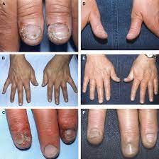 Immunotherapy for recalcitrant, recurrent or extensive warts, e.g. Recalcitrant Warts Associated With Natural Killer Cell Dysfunction Treated With Systemic Ifn A Journal Of Allergy And Clinical Immunology