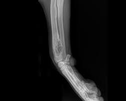 Image result for Osteosarcoma