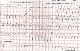 Image result for Left Bundle Branch Block