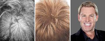 The truth is, you can't prevent hair loss yourself, you need the medically and scientifically backed hair loss treatments that only advanced hair studio can offer. Hair Loss Treatment Hair Replacement Results Ahs Uae