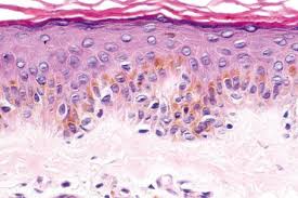 We interpret this lesion as agminated blue naevi in association with lentigo simplex, an unusual variant of speckled lentiginous naevus. Melanocytic Nevi Basicmedical Key