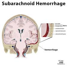Read More Here Http Radiopaedia Org Articles Subarachnoid Haemorrhage Subarachnoid Hemorrhage Intracranial Hemorrhage Hemorrhage