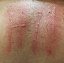 We did not find results for: An Activity Induced Rash Photo Quiz American Family Physician