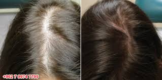 تجربتي مع تقنية حقن البلازما للشعر Hair Styles Hair Plasma Injections