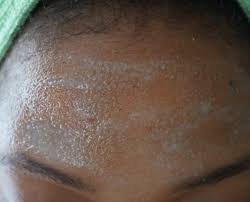 Bacteria infect the clogged follicle and cause pimples. Nizoral Shampoo For Pityrosporum Folliculitis Malassezia Folliculitis