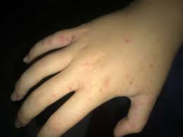 Blaschen An Der Hand Und Am Bauch Ausschlag Gesundheit Und Medizin Gesundheit Korper