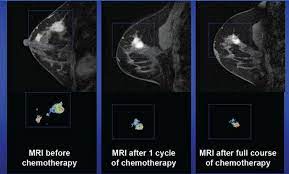 It is often done in women who have already been diagnosed with breast cancer to measure size and. Breast Cancer Research Interest Group Ucsf Radiology