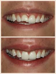 Pin On Dental Before Afters