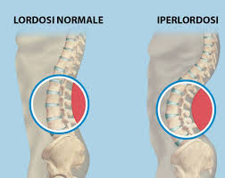 Contrai i muscoli del core e assicurati di formare una linea dritta con il corpo, dalla testa a i. Migliorare La Postura Della Schiena Esercizi Per Ipo E Iper Lordosi Lombare L Altra Riabilitazione