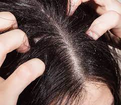 Jadi, selain rasa gatal karena ketombe teratasi, rambut rontok pun akan berkurang. Ketombe Dan Rambut Rontok Ini 3 Cara Atasinya Erhastory