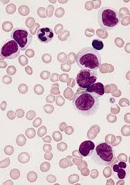 Este tipo de cáncer suele empeorar rápido si no se trata. Se Identifican Las Celulas De La Leucemia Mieloide Aguda Resistentes A La Quimioterapia Genotipia