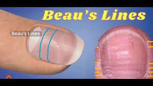 Image result for Beau lines feet