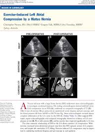 A part of the stomach herniates through the esophageal opening leading to hiatus hernia. Exercise Induced Left Atrial Compression By A Hiatus Hernia Journal Of The American College Of Cardiology