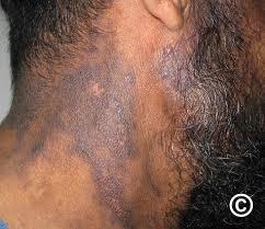 Image result for Diffuse Hyperpigmentation