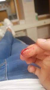 Eine schnittwunde kann man sich schnell zufügen. Konnen Bei Der Verletzung Nerven Verletzt Worden Sein Gesundheit Und Medizin