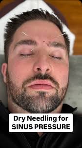 Struggling with stubborn sinus pressure? 🌀💨 Watch as I break down a  powerful 1-2 punch for relief: Nasal Release Technique to clear congestion  + Dry Needling to reduce tension and improve drainage. ...